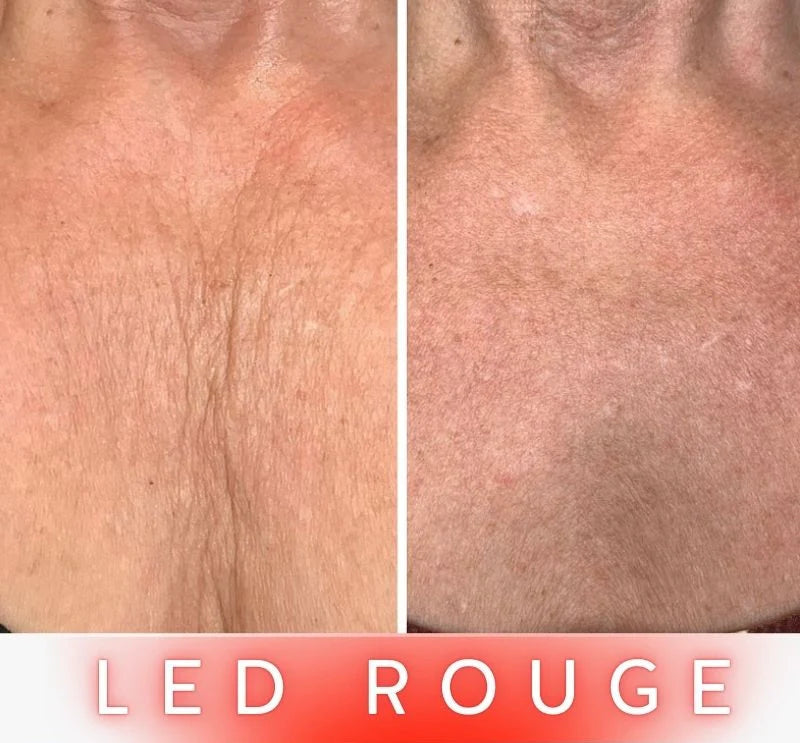 Masque LED Anti-Âge Pro - Cou et Décolleté FontanaySkin