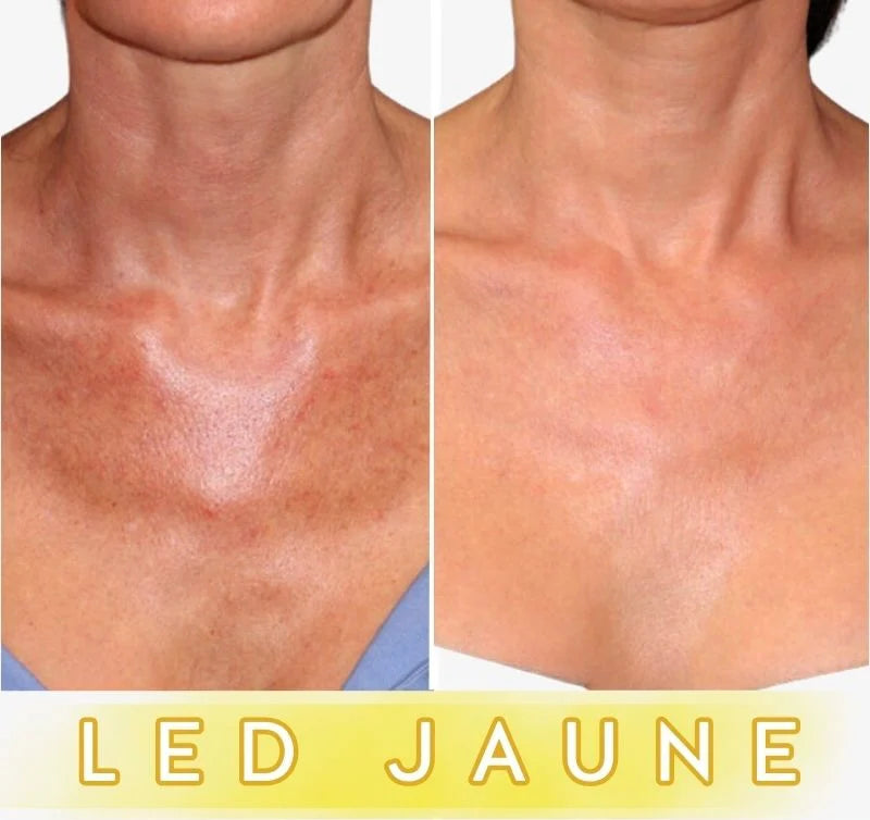 Masque LED Anti-Âge Pro - Cou et Décolleté FontanaySkin